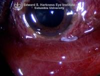 Severe chemosis was observed one day post scleral buckle implantation surgery. The patient experienced symptoms of severe irritation, discharge and blurry vision.
